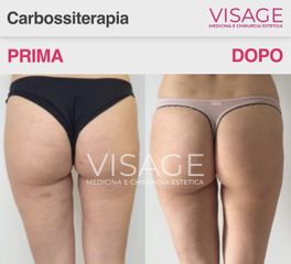 Carbossiterapia - Visage Medicina e Chirurgia Estetica