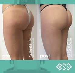 Carbossiterapia - Visage Medicina e Chirurgia Estetica