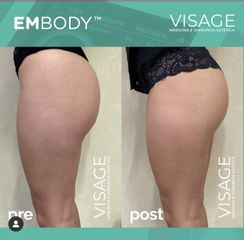 Carbossiterapia - Visage Medicina e Chirurgia Estetica