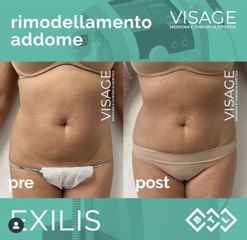 Radiofrequenza - Visage Medicina e Chirurgia Estetica