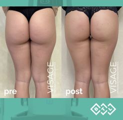 Carbossiterapia - Visage Medicina e Chirurgia Estetica