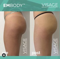 Carbossiterapia - Visage Medicina e Chirurgia Estetica