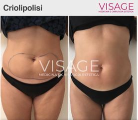 Criolipolisi - Visage Medicina e Chirurgia Estetica
