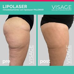 Lipolaser - Clínica Lasery