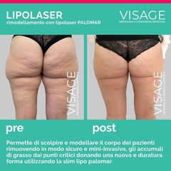 Lipoláser - Visage Medicina e Chirurgia Estetica