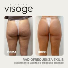 Radiofrequenza - Visage Medicina e Chirurgia Estetica