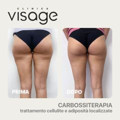 Carbossiterapia - Visage Medicina e Chirurgia Estetica