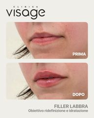 Filler labbra  - Visage Medicina e Chirurgia Estetica