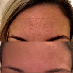 Microneedling prima e dopo