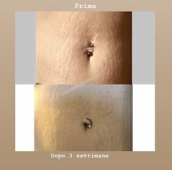 Smagliature - Dr.ssa Elisa Puma