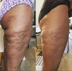 Cellulite - Dr.ssa Elisa Puma