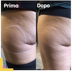 Smagliature - Dr.ssa Elisa Puma