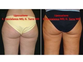 Liposuzione prima e dopo