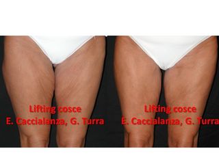 Lifting cosce prima e dopo