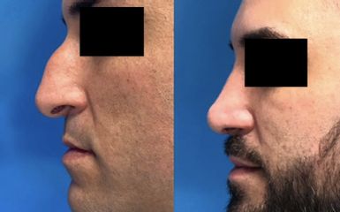 Rinoplastica - Paolo Paccoi - Chirurgia Estetico-Funzionale Nasale