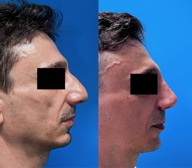 Rinoplastica - Paolo Paccoi - Chirurgia Estetico-Funzionale Nasale