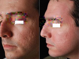 Cicatrice acne prima e dopo