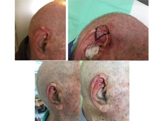 Carcinoma spinocellulare