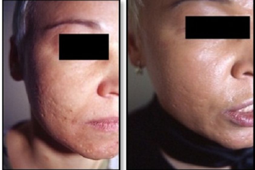 Peeling chimico prima e dopo - 745966