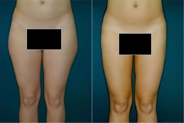 Lipoaspirazione prima e dopo