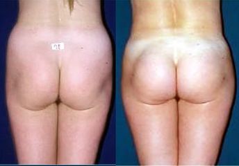 Lipoaspirazione prima e dopo