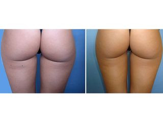 Laserlipolisi prima dopo