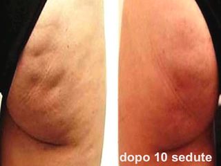 Cellulite prima e dopo