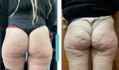 Mesoterapia