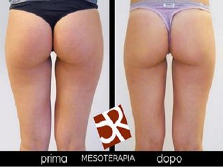 Mesoterapia prima e dopo