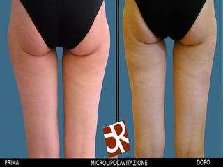 Microlipocavitazione prima e dopo