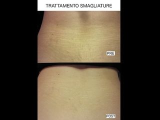 Smagliature prima e dopo