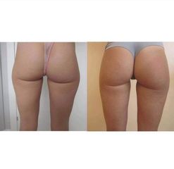 Liposuzione - Dott.ssa Sara Russo