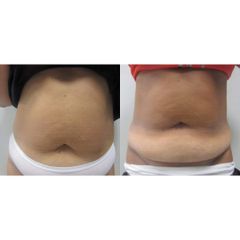 Liposuzione - Dott.ssa Sara Russo