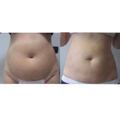 Liposuzione - Dott.ssa Sara Russo