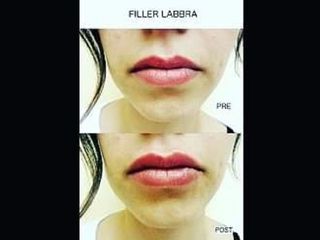 Filler labbra - Dott.ssa Sara Russo