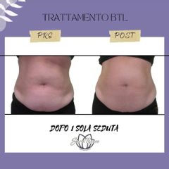 Liposuzione - Dott.ssa Sara Russo
