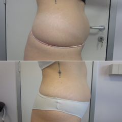 Dott.ssa Sara Russo Trattamento LESC o Microlipocavitazione