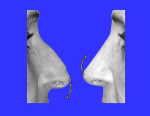 Ricostruzione punta nasale caduta con il passare degli anni e miglioramento del profilo