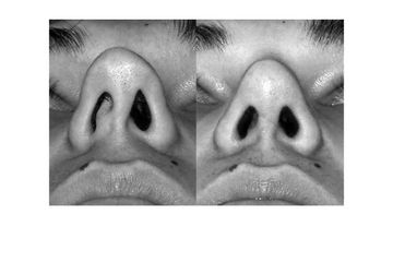 Rinosettoplastica funzionale per ostruzione narice sinistra