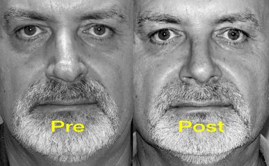 Naso deviato e deformità della punta nasale - Ricostruzione Nasale