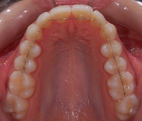 Ortodonzia invisibile