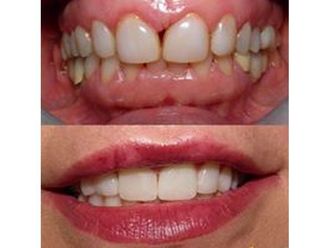 Faccette dentali - 769807