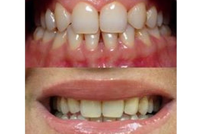 Faccette dentali prima e dopo - 769808