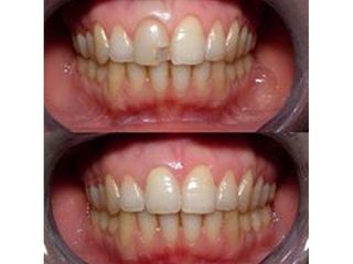 Faccette dentali prima e dopo