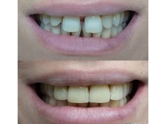 Faccette dentali - 769813