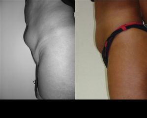 liposuzione prima e dopo