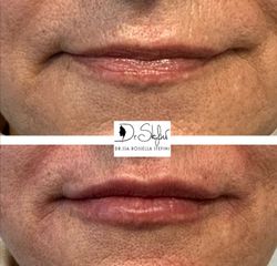 Filler labbra - Dr.ssa Rossella Stefini