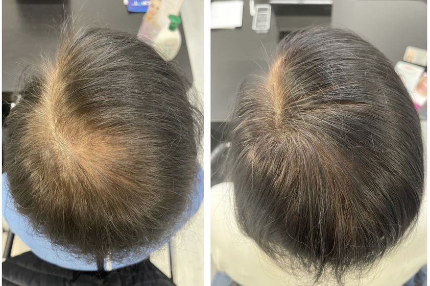 Alopecia prima e dopo - 877814