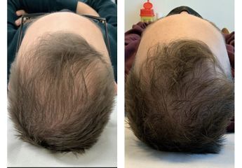 Dr.ssa Rossella Stefini Alopecia