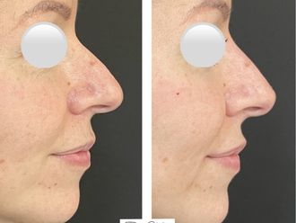 Filler prima e dopo - 877816